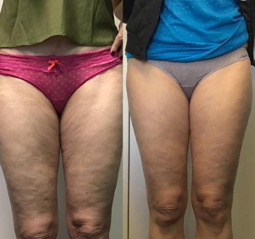 Cellulite massager customer result