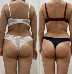 Skin tightening result