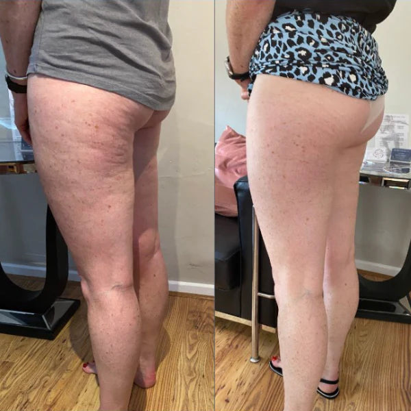 Cellulite reduction testimonial