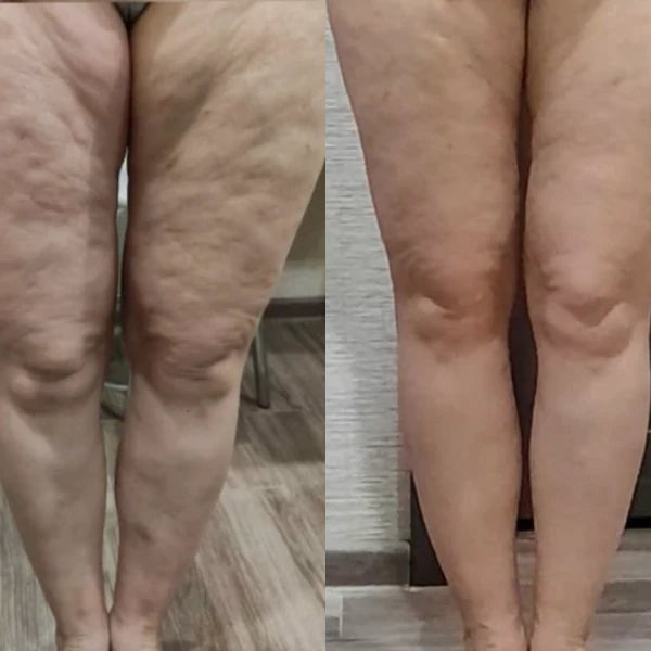 Cellulite reduction result