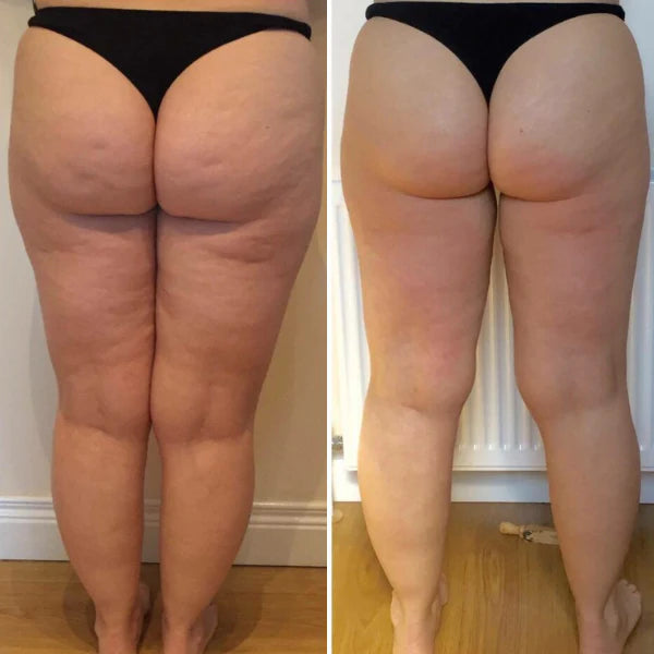 Before and after cellulite massager